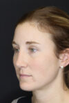 Revision Rhinoplasty case #4221