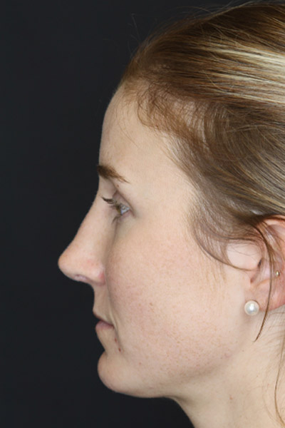 Revision Rhinoplasty case #4221