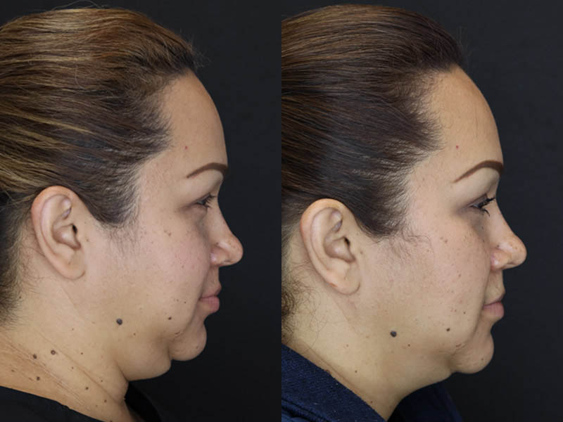 Buccal Fat Removal case #4289