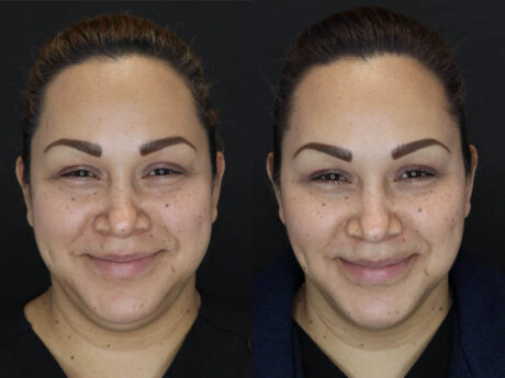 Buccal Fat Removal case #4289