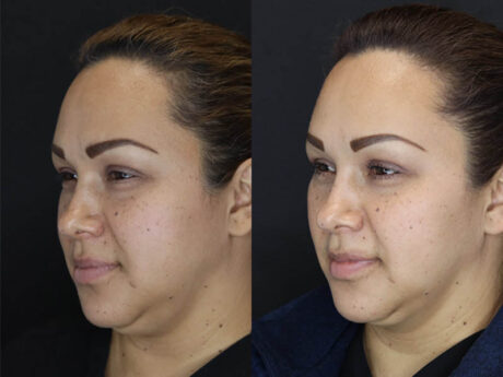 Buccal Fat Removal case #4289