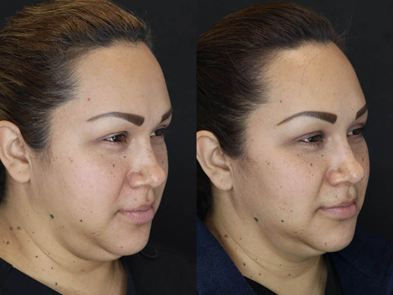Buccal Fat Removal case #4289