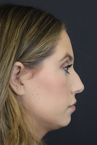 Chin Augmentation case #4143