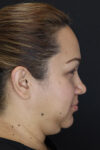 Buccal Fat Removal case #4289