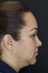 Buccal Fat Removal case #4289