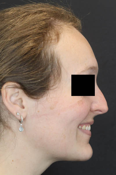 Rhinoplasty case #4367