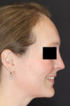 Rhinoplasty case #4367