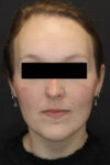 Rhinoplasty case #4367