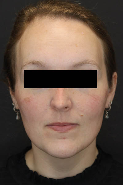 Rhinoplasty case #4367