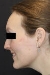 Rhinoplasty case #4367