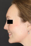 Rhinoplasty case #4367