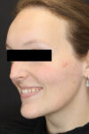 Rhinoplasty case #4367