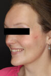 Rhinoplasty case #4367