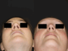 Rhinoplasty case #4367 slider thumbnail