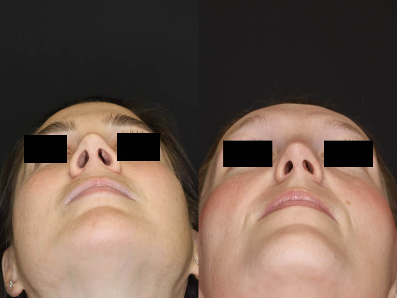 Rhinoplasty case #4367