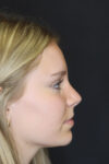 Rhinoplasty case #4237