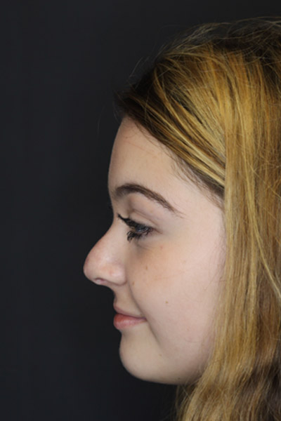 Revision Rhinoplasty case #4156