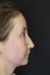 Rhinoplasty case #4104