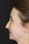 Rhinoplasty case #4104