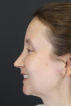 Rhinoplasty case #4104