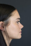 Rhinoplasty case #4321