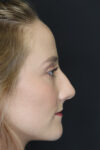 Rhinoplasty case #4334