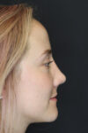 Rhinoplasty case #4334