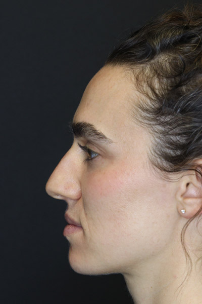 Rhinoplasty case #4383