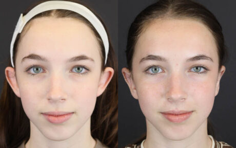 Otoplasty case #4935