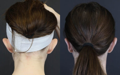 Otoplasty case #4935