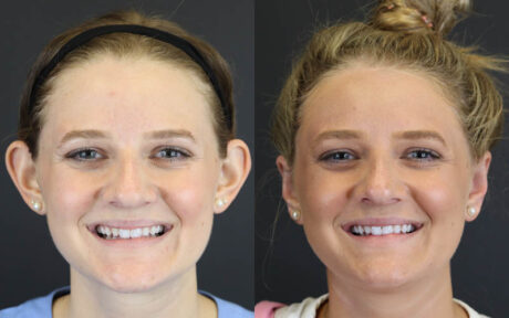 Otoplasty case #4942