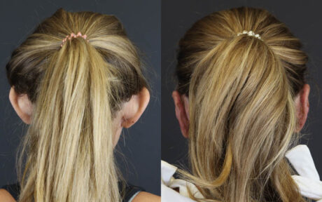 Otoplasty case #4942