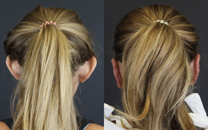 Otoplasty case #4942