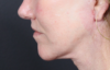 Lip Lift case #4983