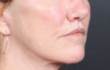 Lip Lift case #4983