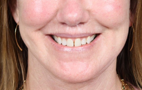 Lip Lift case #4983