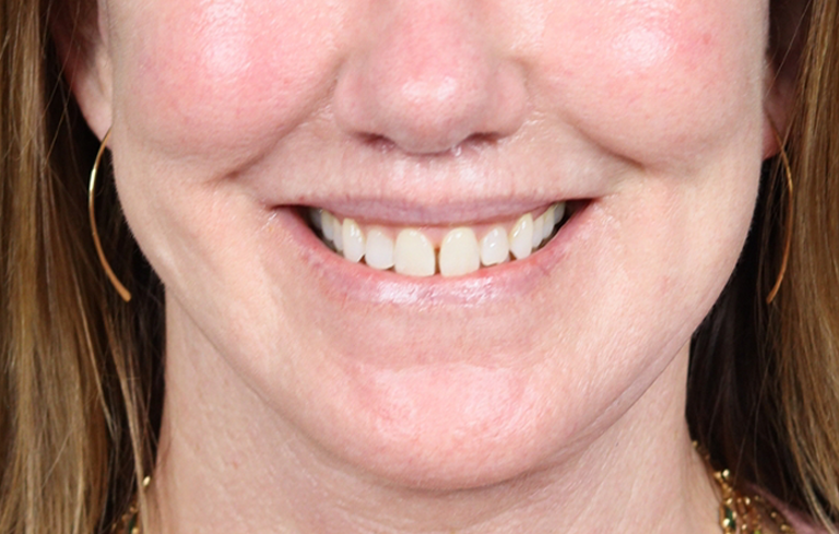 Lip Lift case #4983