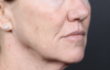 Lip Lift case #4983