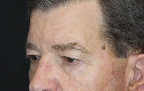 Blepharoplasty case #5280