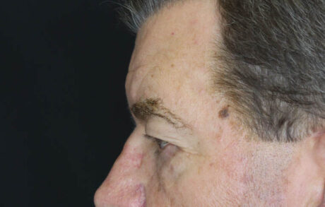 Blepharoplasty case #5280