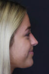 Revision Rhinoplasty case #5304