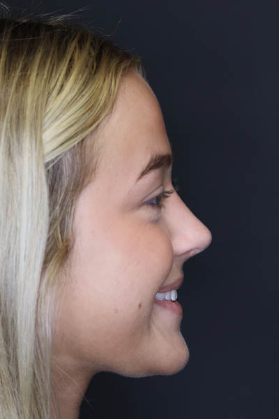 Revision Rhinoplasty case #5304