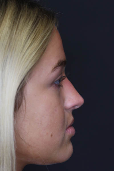 Revision Rhinoplasty case #5304