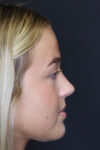 Revision Rhinoplasty case #5304