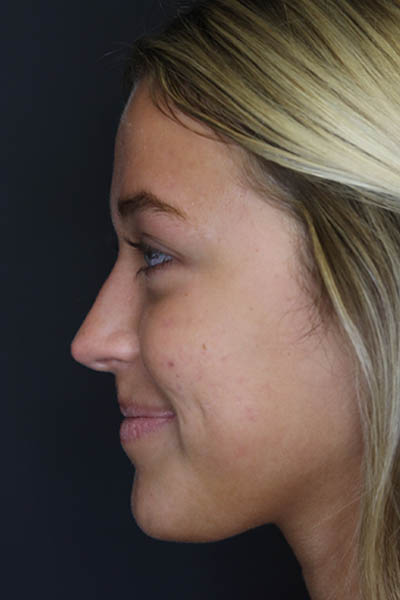 Revision Rhinoplasty case #5304