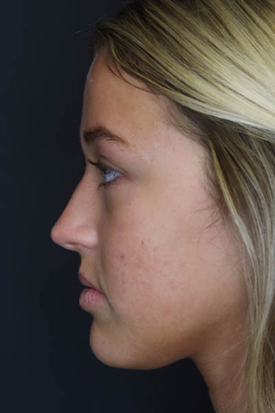 Revision Rhinoplasty case #5304