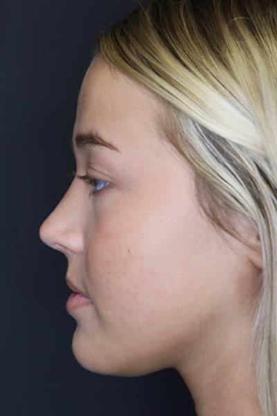 Revision Rhinoplasty case #5304