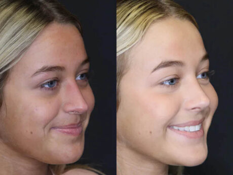 Revision Rhinoplasty case #5304