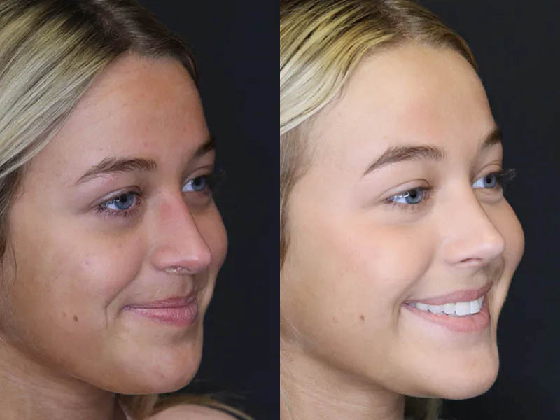 Revision Rhinoplasty case #5304