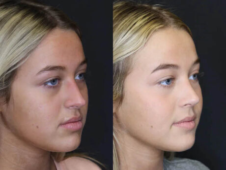 Revision Rhinoplasty case #5304